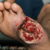 A severe diabetic foot ulcer showing deep tissue damage and infection, highlighting the importance of timely Diabetic Foot Care.