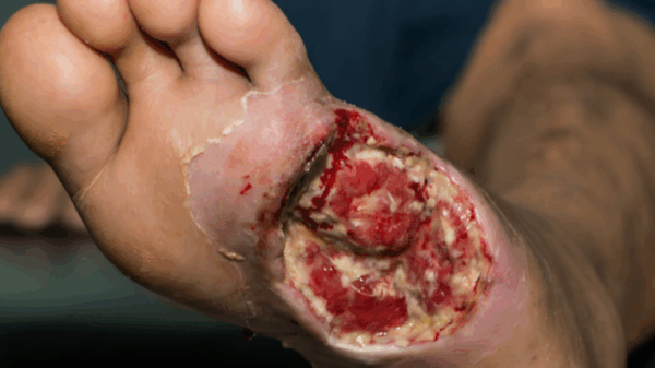 A severe diabetic foot ulcer showing deep tissue damage and infection, highlighting the importance of timely Diabetic Foot Care.
