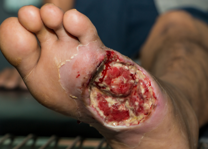 A severe diabetic foot ulcer showing deep tissue damage and infection, highlighting the importance of timely Diabetic Foot Care.